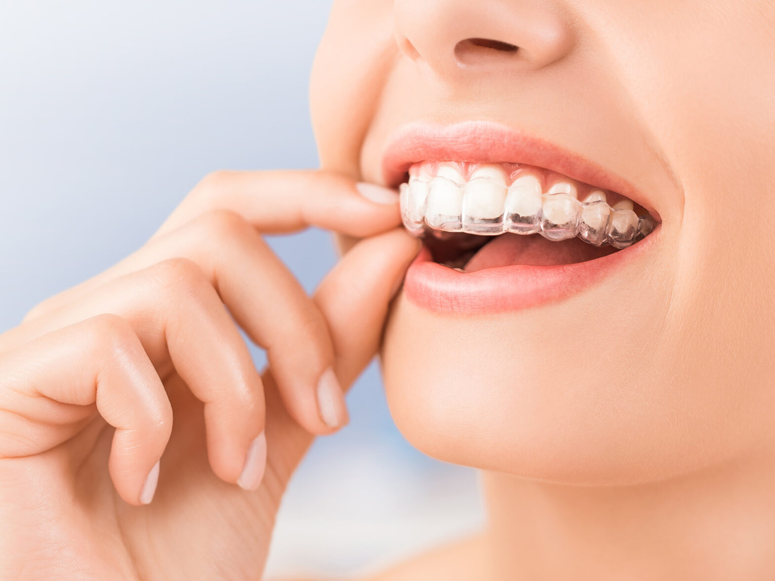 Give a treat to your smile with the magic of invisible braces